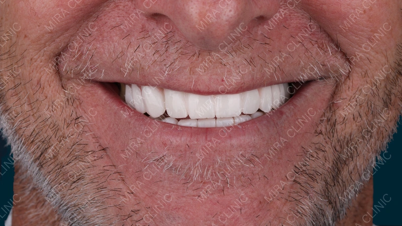 veneers smile width